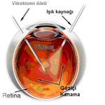 Vitrektomi Nedir?